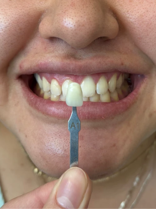 Antes del tratamiento de Denisse