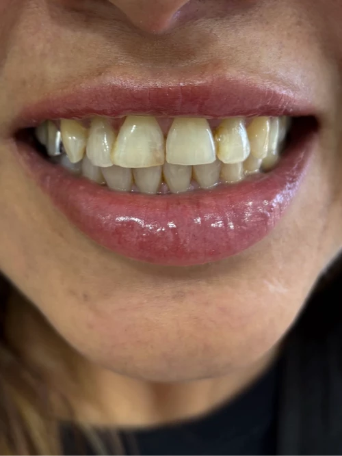 Antes del tratamiento de Georgina