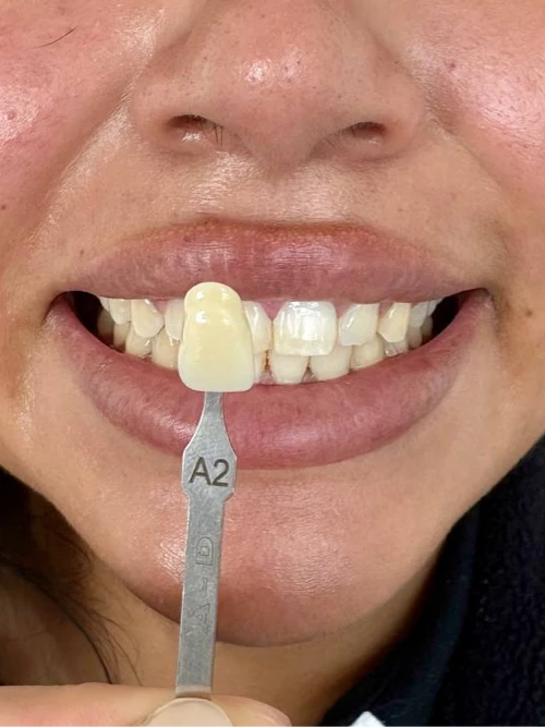 Antes del tratamiento de Pao