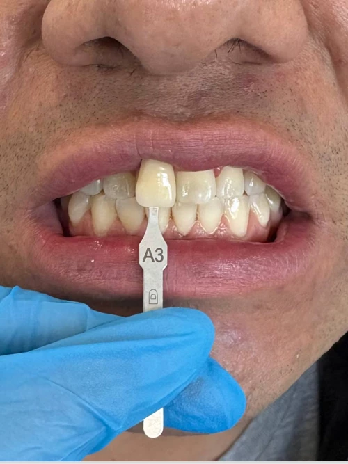 Antes del tratamiento de William